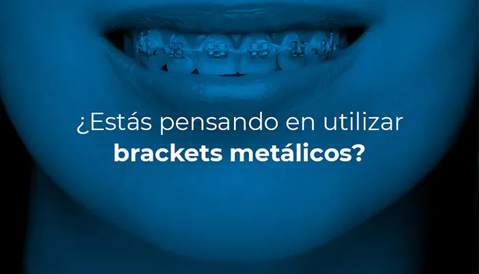  ¿Estás pensando en utilizar brackets metálicos?